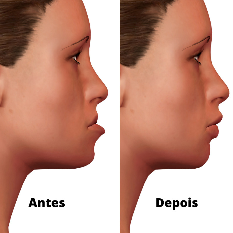 Imagem ilustrativa de para que serve ortognatica cirurgia